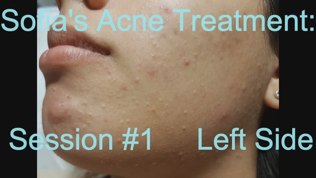Sofia’s Acne Treatment:  Session #1 –  Left side