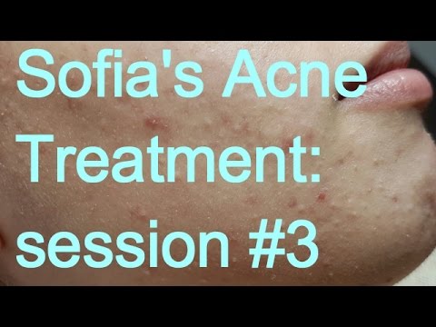 Sofia’s Acne Treatment: Session #3 – Part II
