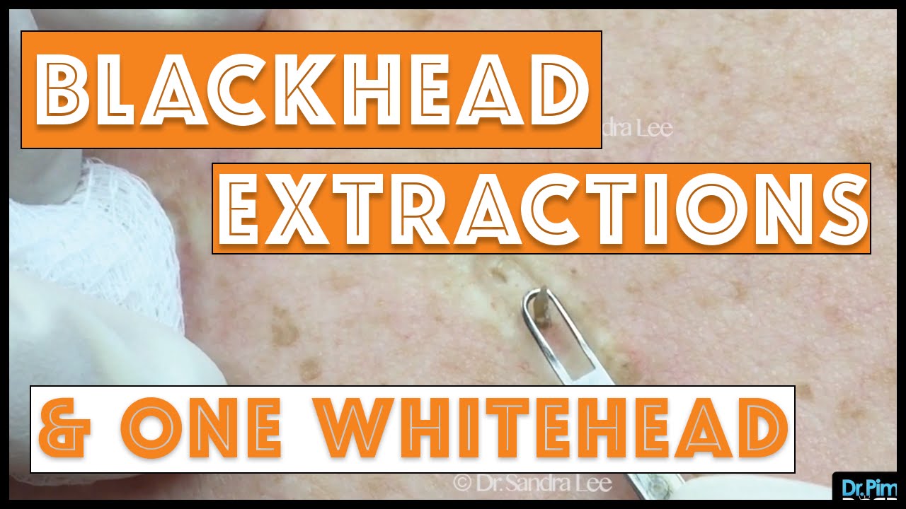 Some of This Week's Blackhead Extractions