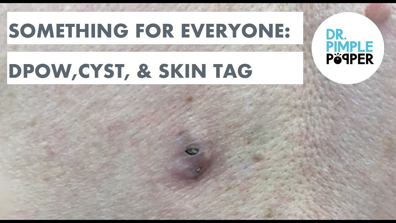 Something for Everyone: A Dilated Pore of Winer, Cyst, & Skin Tag