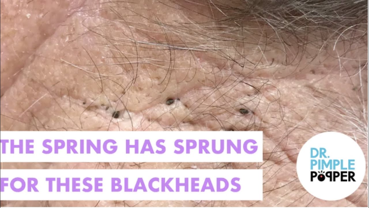 Spring Has Sprung for Blackheads