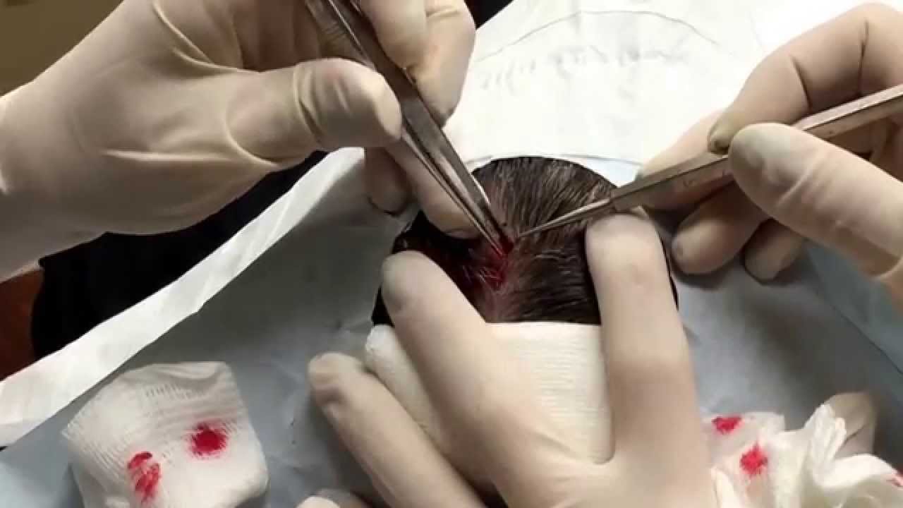Squeezed out this pilar cyst – the sac was too friable. For medical education- NSFE.