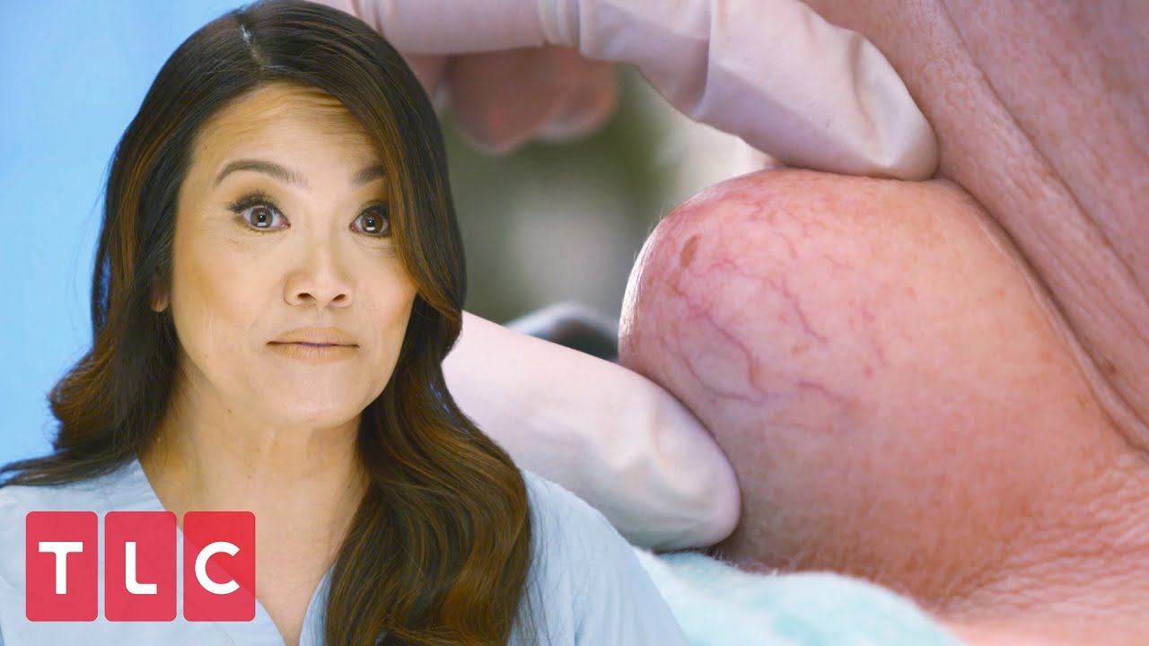 Squeezing a Throbbing Neck Cyst | Dr. Pimple Popper