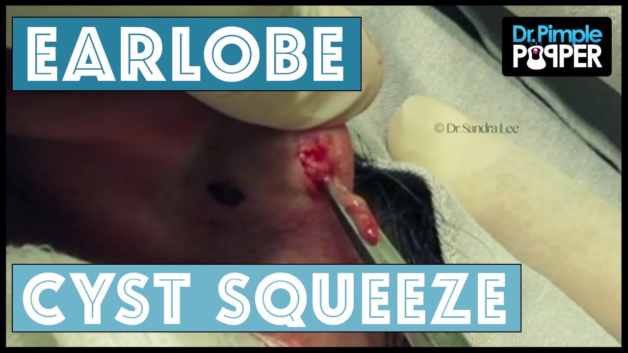 Squeezing Annoying Earlobe Cysts, bilaterally