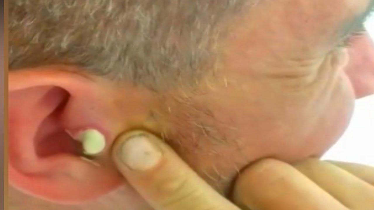 Squeezing Roufas’ Big Ear Pimple: Dermatology Case Study ???