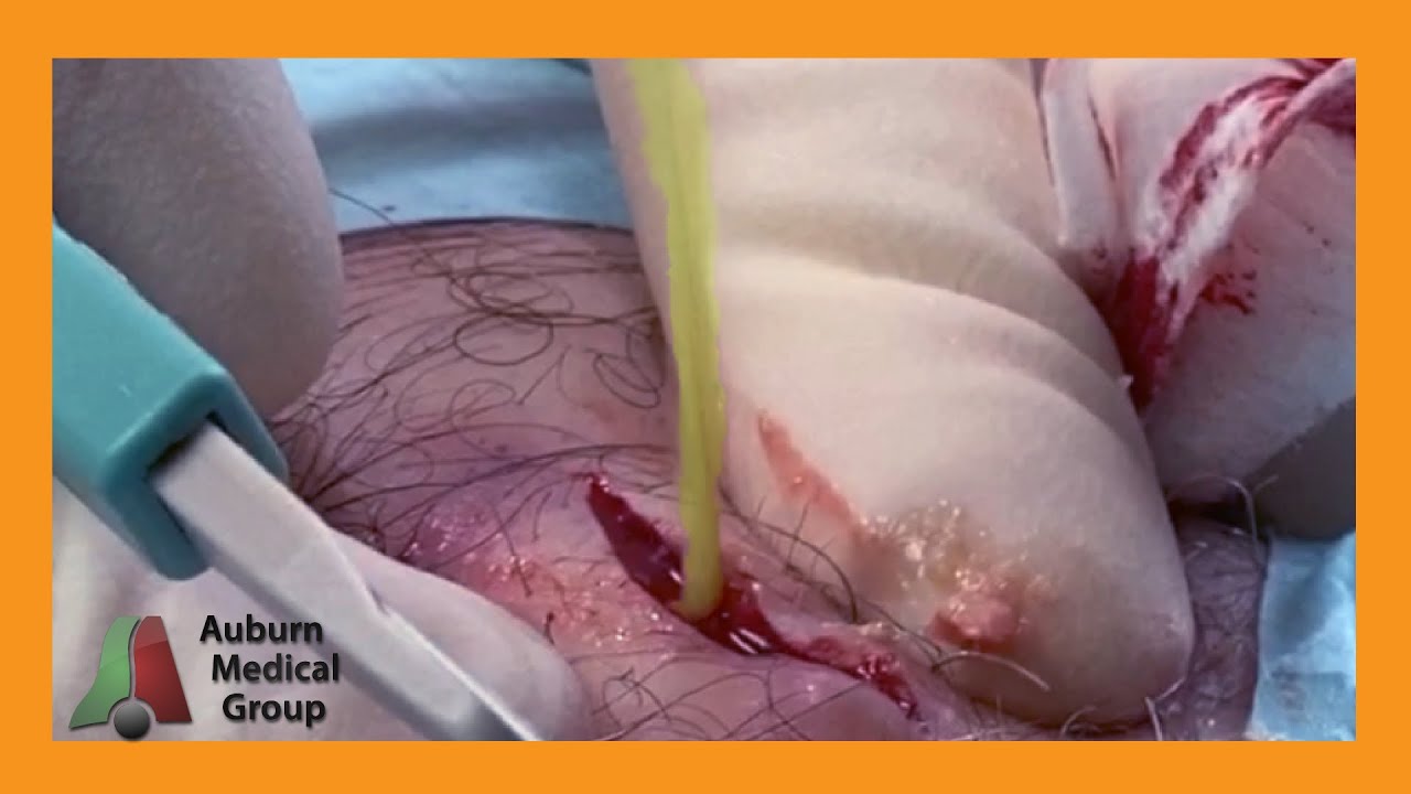 Squirting Cyst | Auburn Medical Group