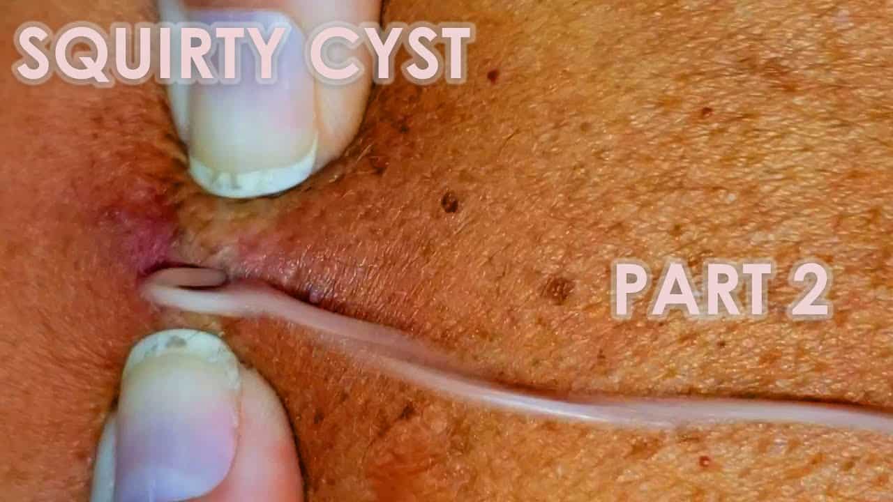 Squirty Cyst Part 2