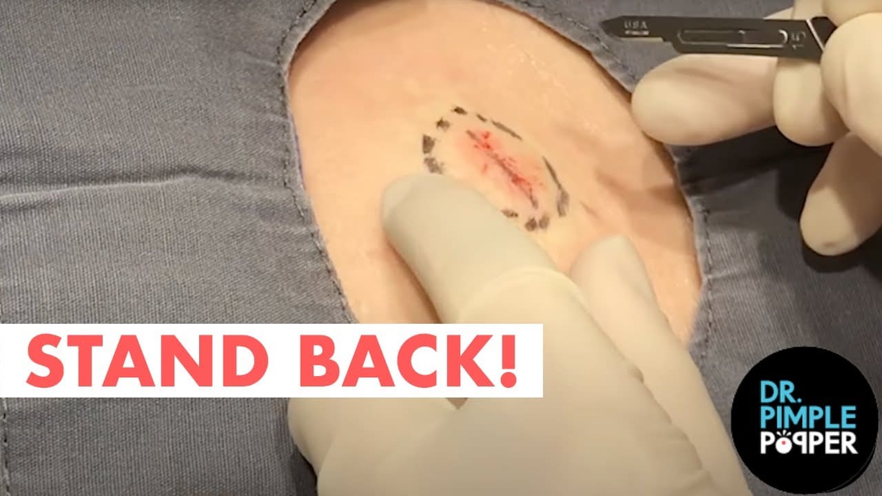 Stand Back! Road Trip Cyst Removal & Cut
