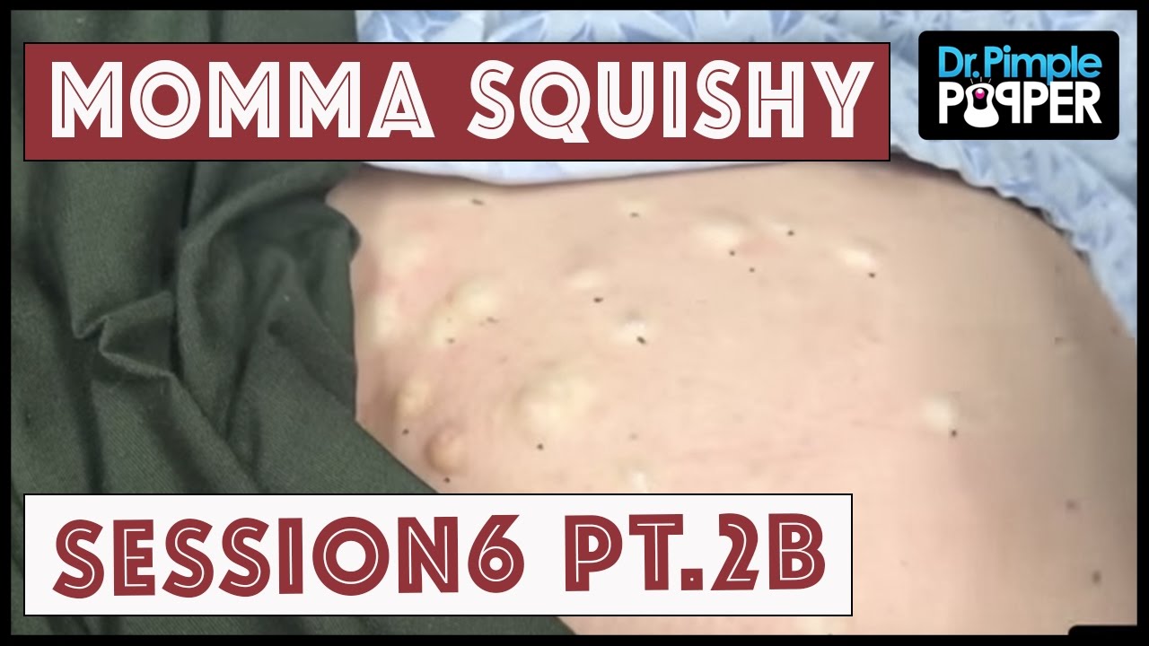 Steatocystomas & Momma Squishy: Session 6 Part 2B