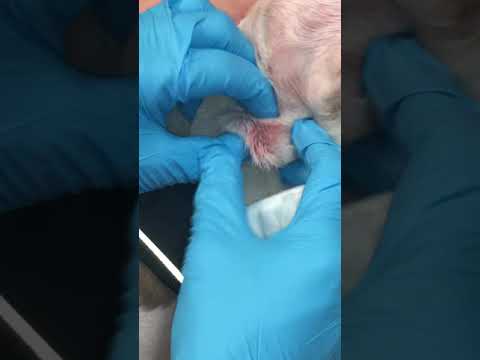 Stella’s Cyst Removal