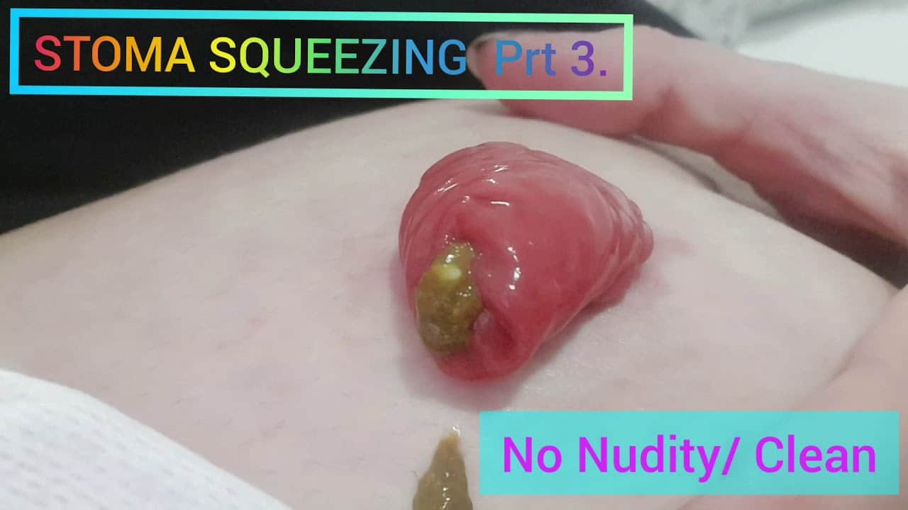 STOMA SQUEEZING PART 3. Pimple Popping Extreme