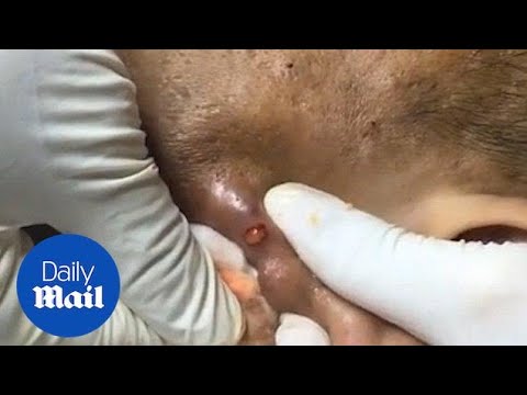 Stomach-churning moment enormous zit on ear is popped – Daily Mail
