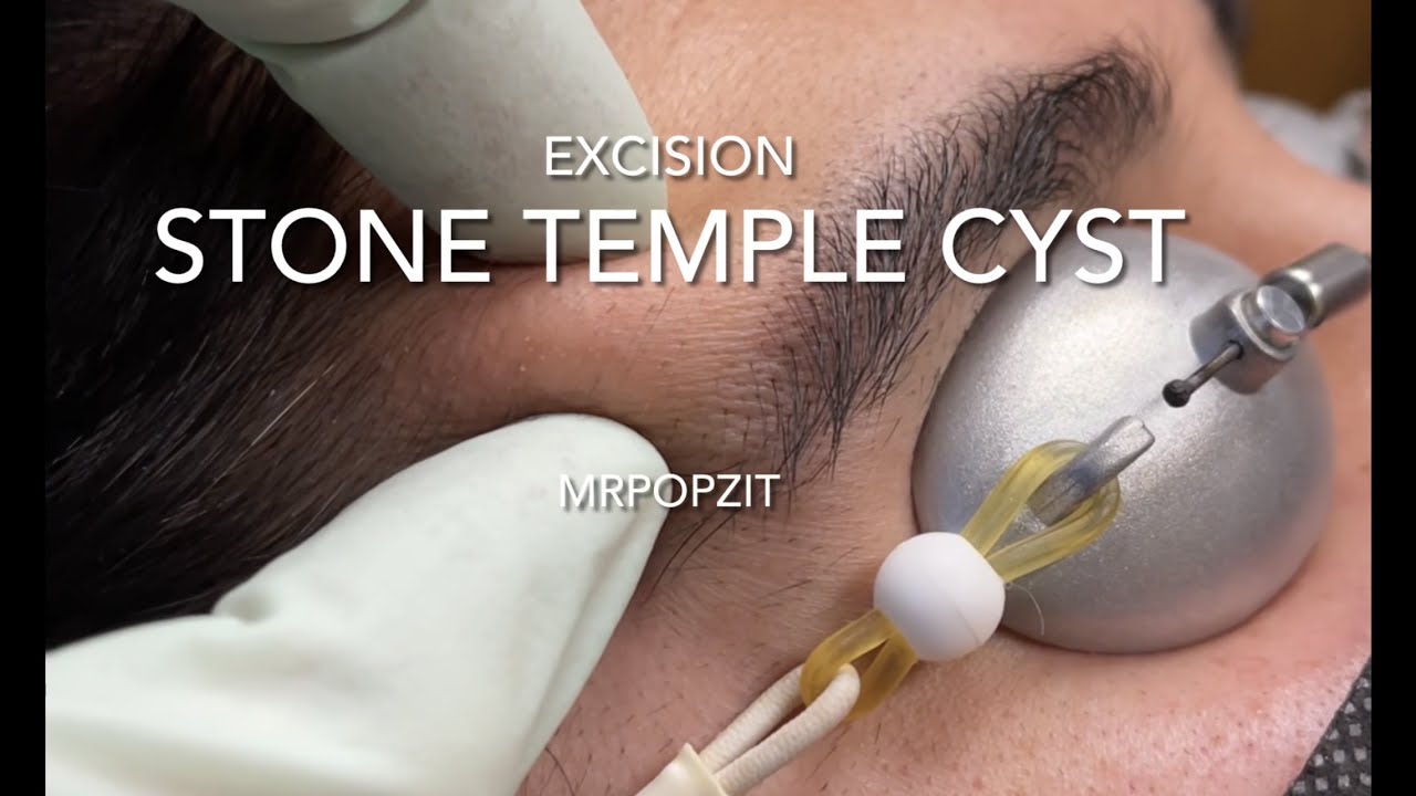 Stone Temple Cyst tug of war. Large calcified cyst on temple excision. Hard as a rock. MrPopZit