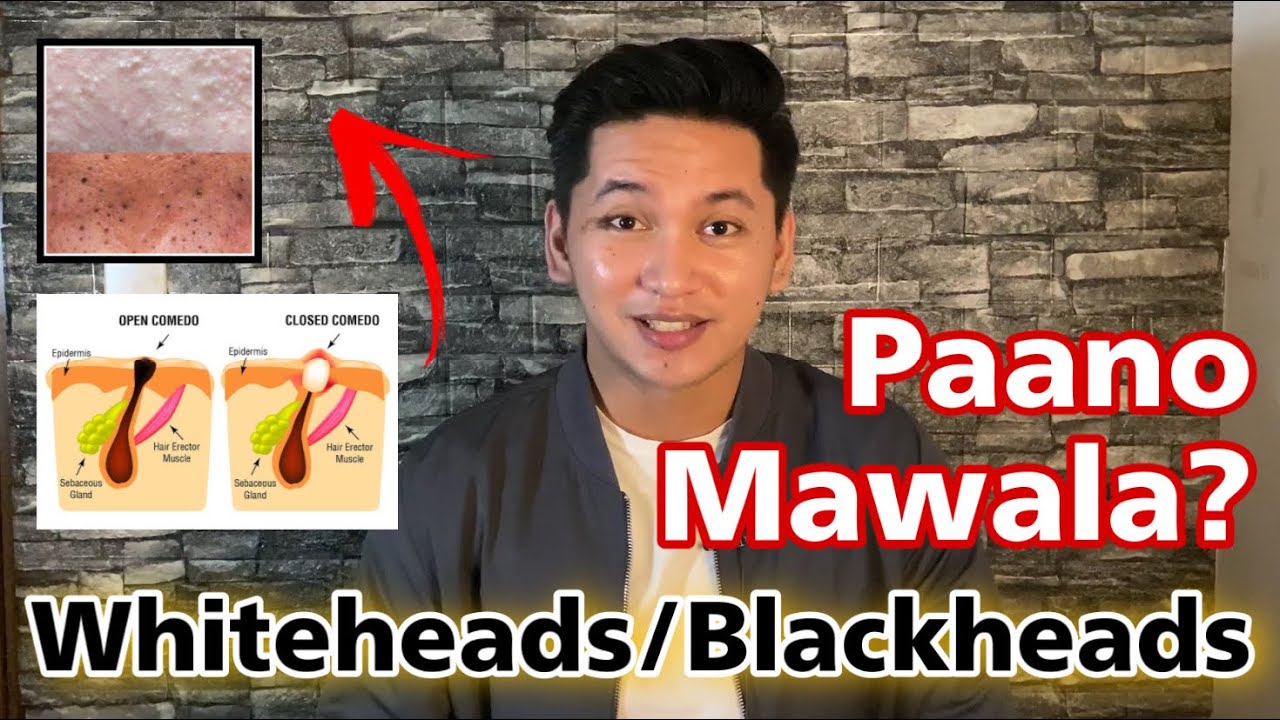 STOP Whiteheads & Blackheads NOW with these tips | Paano Mawala Blackheads Whiteheads