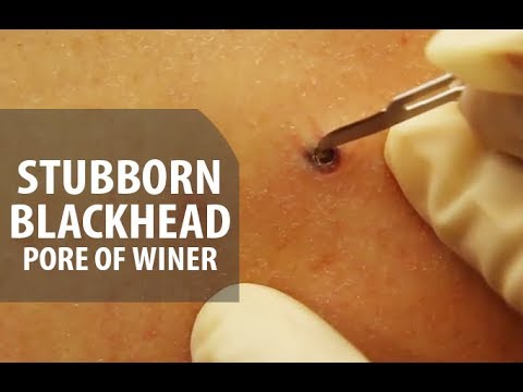 Stubborn Blackhead Removal | Dr. Derm