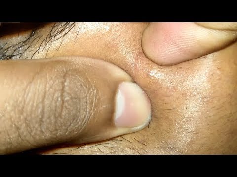 Stuck in the face- Pimple Popper #pimple #popping