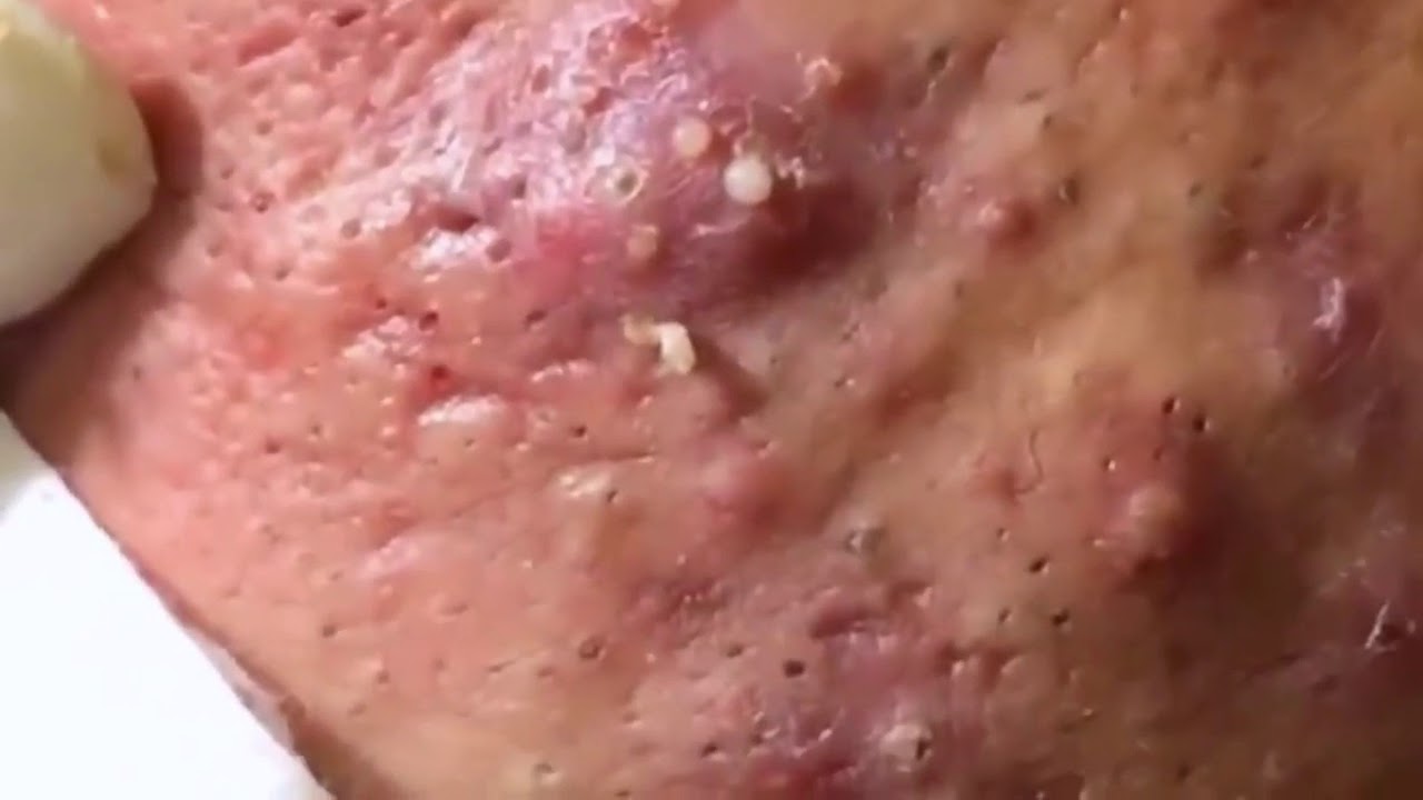 Summary of the most terrifying acne spots. ( past 17 )