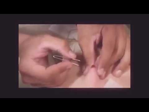 Super acne l Pimple popping at home l Zit popping 2016 l By Amazing pimple popper