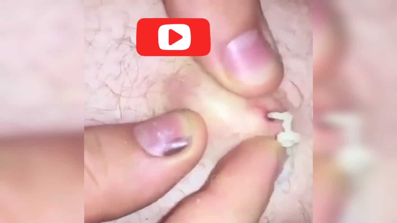 Super Blackheads Pimples Popping | Cysts Removal on Cheeks | So Many Pimple Pops | You Like