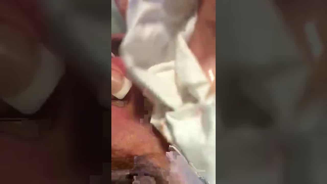 Super disgusting ear cyst being popped
