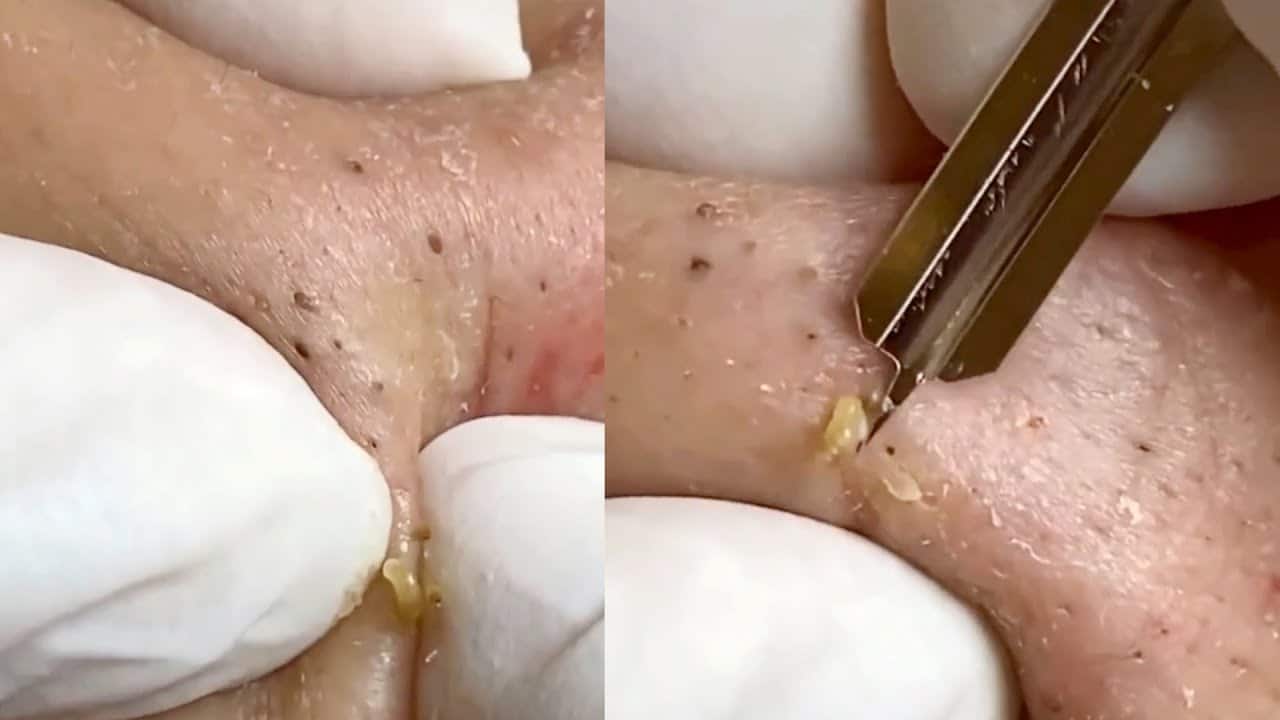 Super Satisfying Blackhead Removal-Ep2 #pimple popping