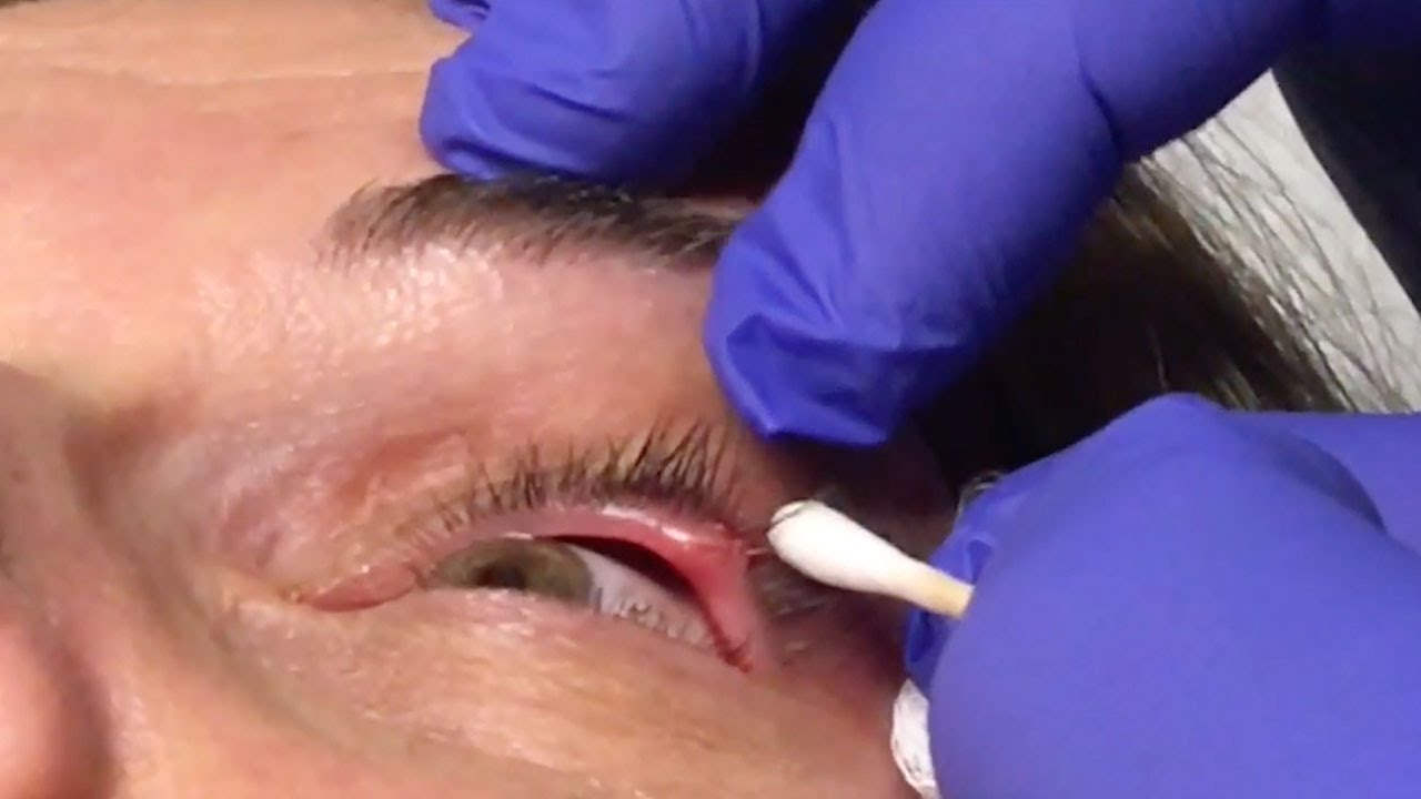 Surgeon Drains Stye On Womans Eye