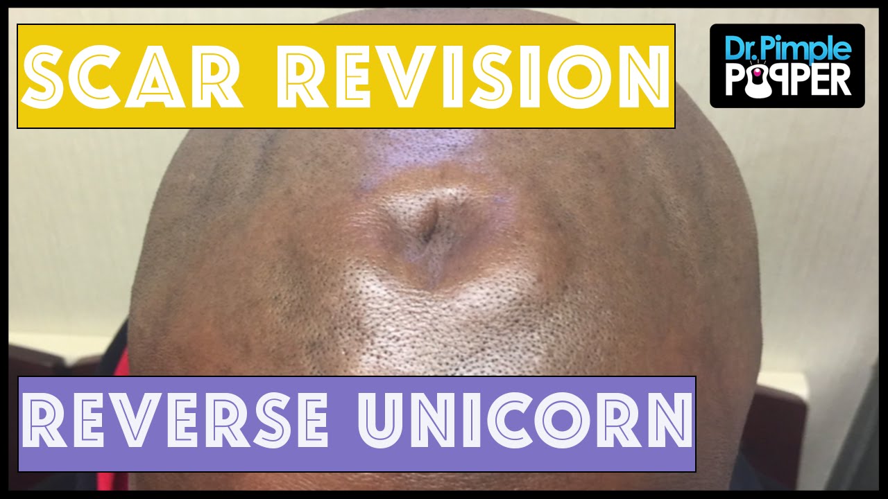 Surgical Correction of the “Reverse Unicorn”