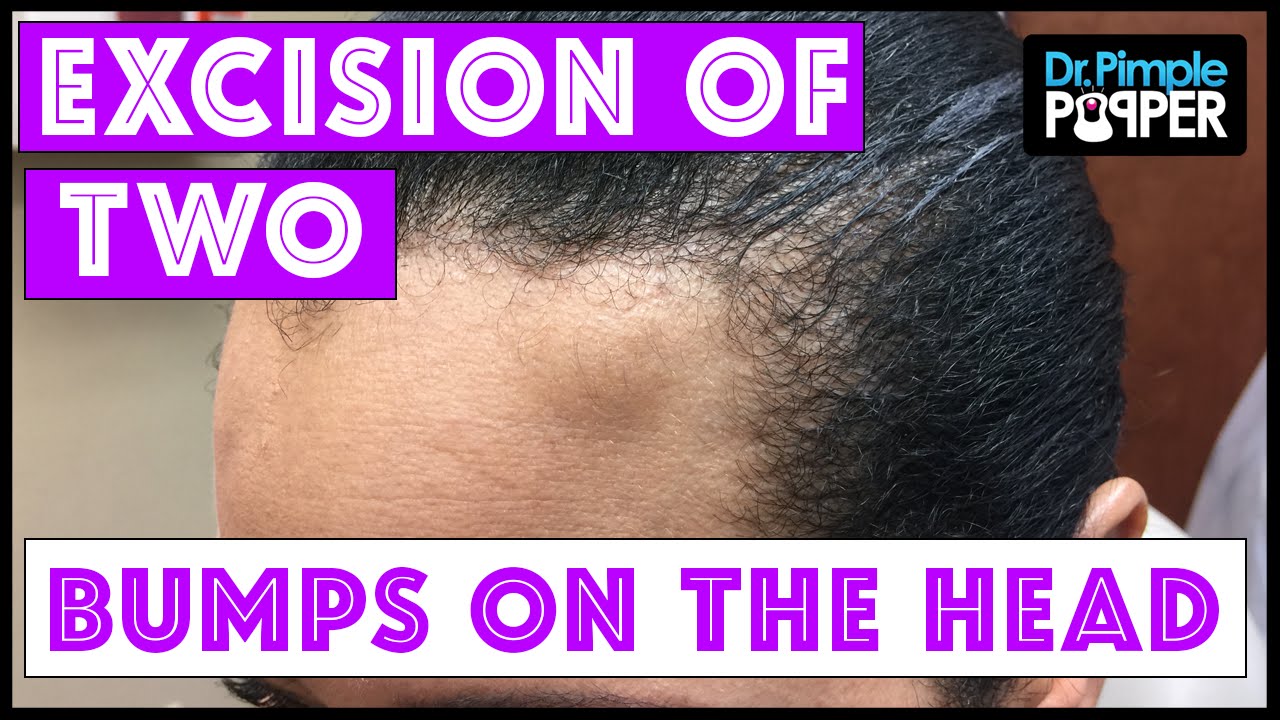 Surgical removal of two different bumps on the head