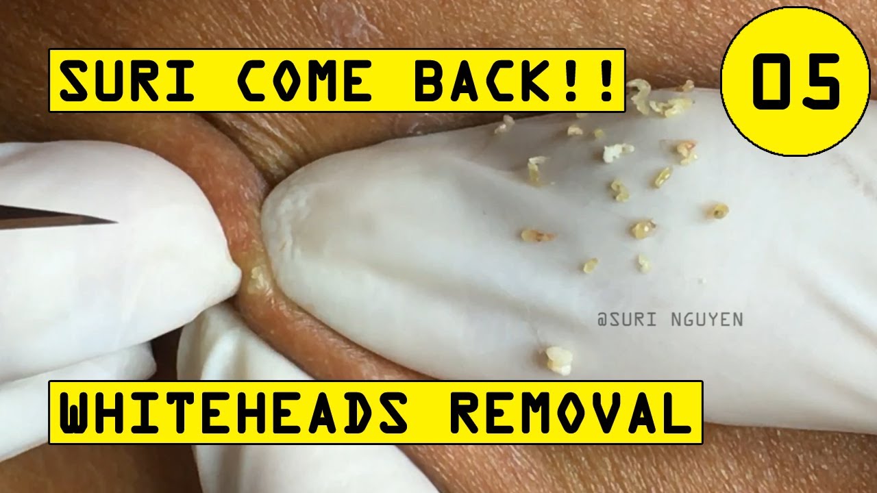 SURI COME BACK | WHITEHEADS REMOVAL