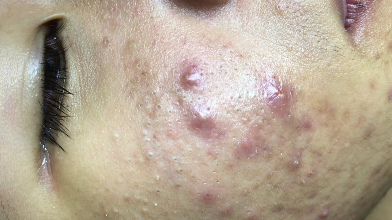 Suri Job 101: AWESOME INFLAMED BLACKHEADS FIELD | PART 1
