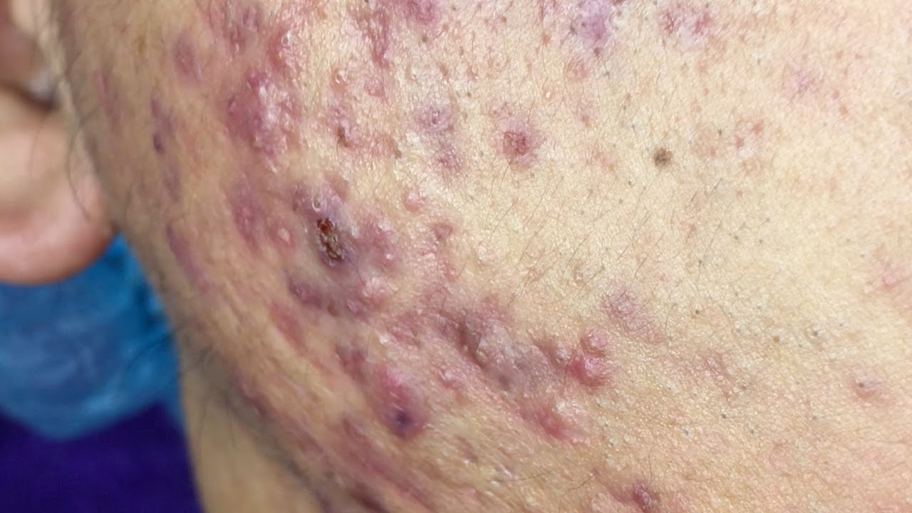 Suri Job 32: AWESOME INFLAMED BLACKHEADS POPPING