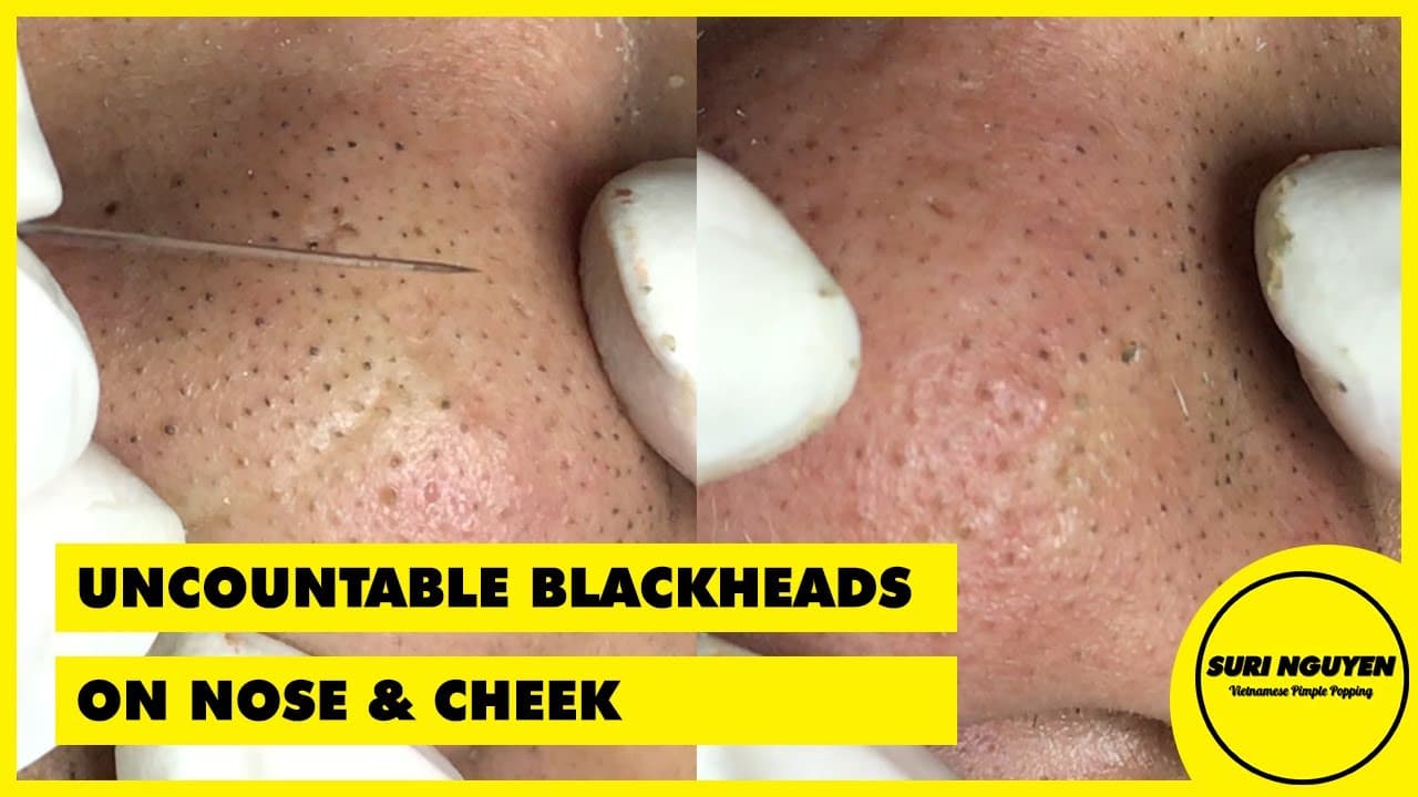 Suri Job 38: UNCOUNTABLE BLACKHEADS ON NOSE AND CHEEK