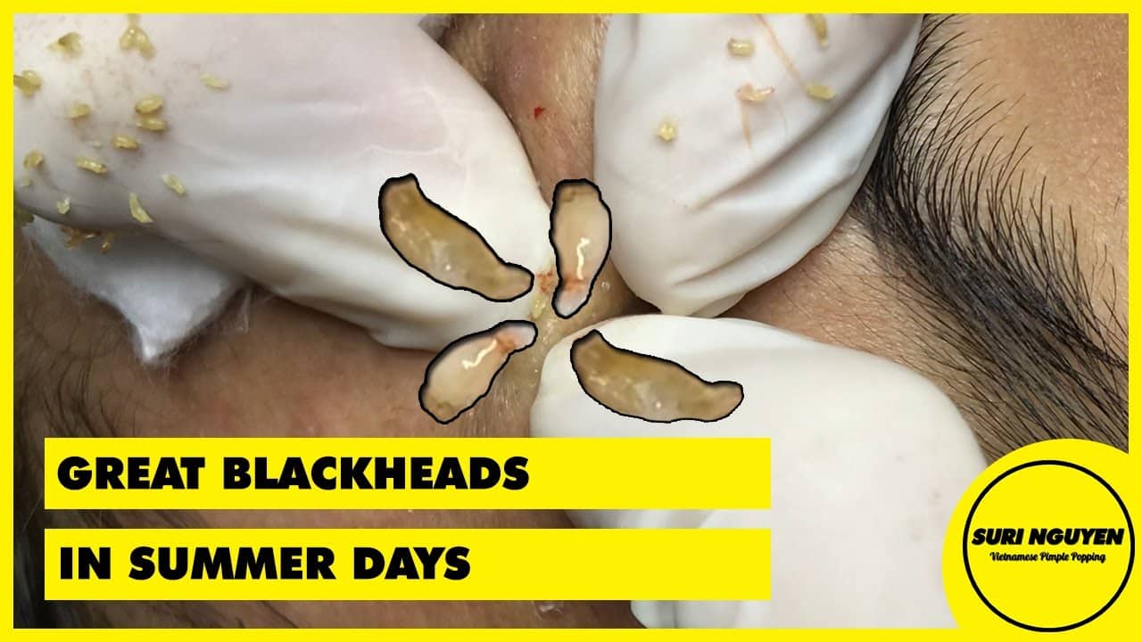 Suri Job 44: GREAT BLACKHEADS POPPING IN SUMMER DAYS