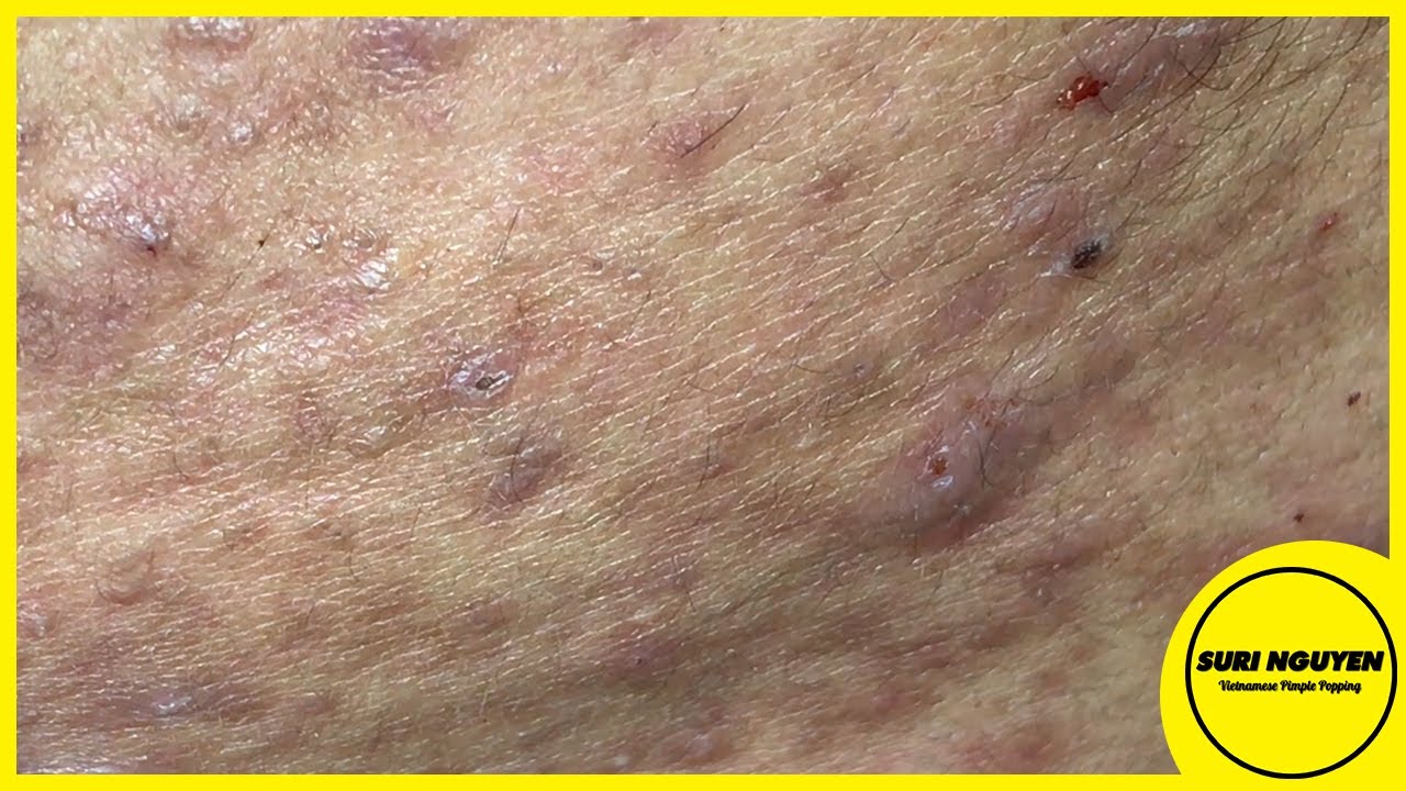 Suri Job 60: EXTRACTION INFLAMED ACNE ON CHIN