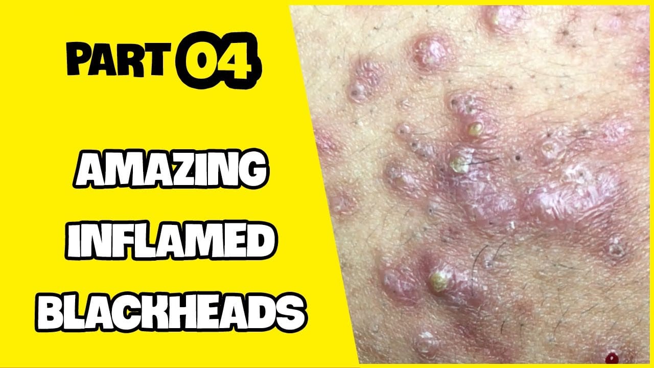 Suri Series 01: AMAZING INFLAMED BLACKHEADS POPPING | PART 4