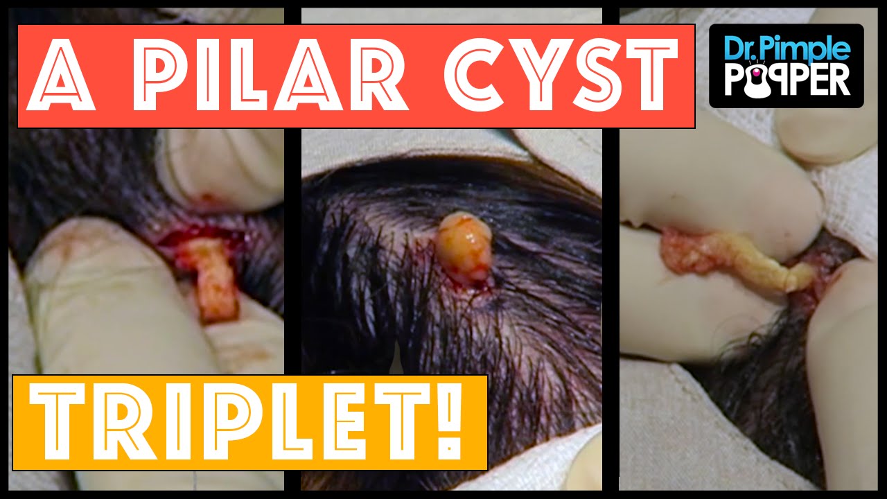Surprise, it’s TRIPLETS! Pilar Cysts with Dr Pimple Popper!