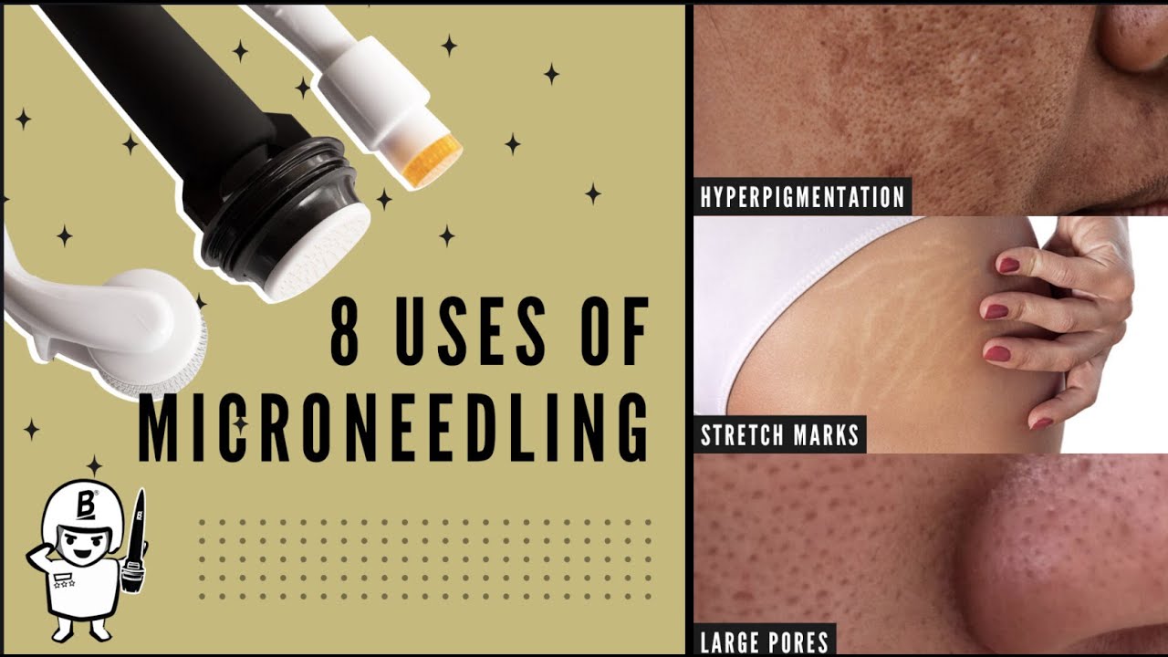 SURPRISING USES OF MICRONEEDLING YOU MAY NOT KNOW ABOUT!