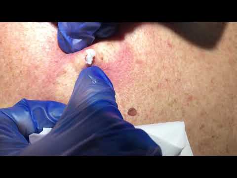 Swedish super pimple – never ending story – pimple popping back