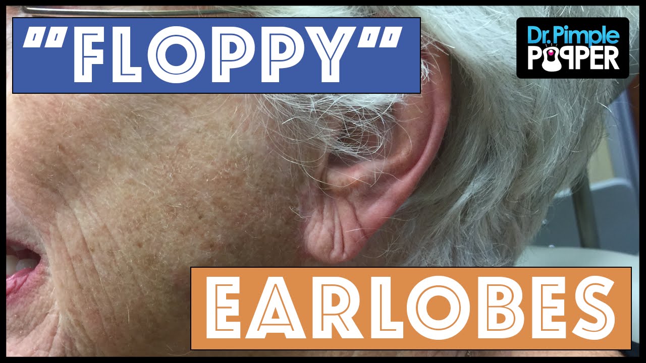 Taking 20 years off an Earlobe: Earlobe Thinning with Dr Pimple Popper