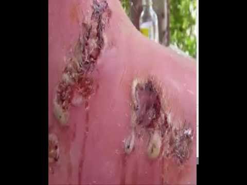 tattoo went wrong popping infected cyst 2016!
