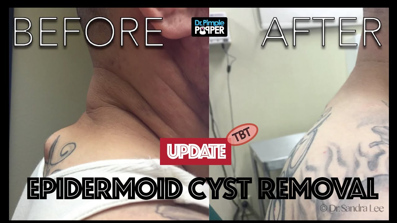TBT: Cyst excision on Upper back with overlying tattoo:  An update