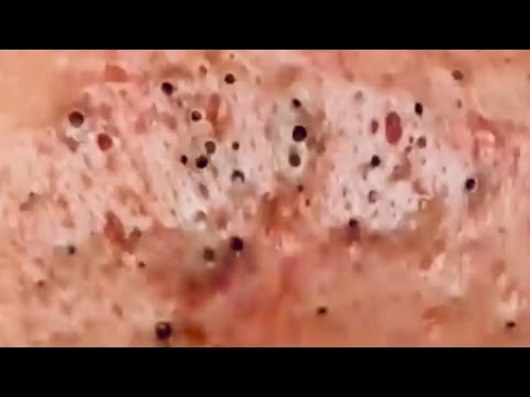 Technical acne removal – Pimple popping videos