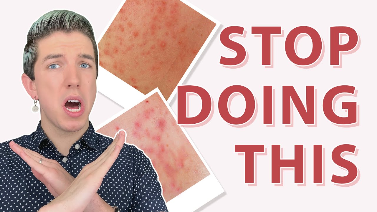 Teen Acne: What to STOP Doing