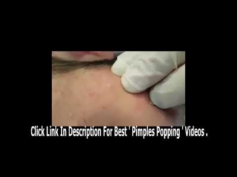 Teenage pimple popping   Most Amazing Pop