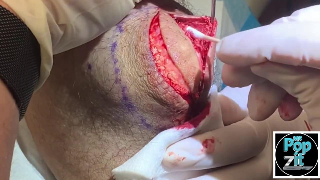 Tennis ball elbow cyst with mayonnaise pocket. Huge calcified cyst removal. Must see custard pocket
