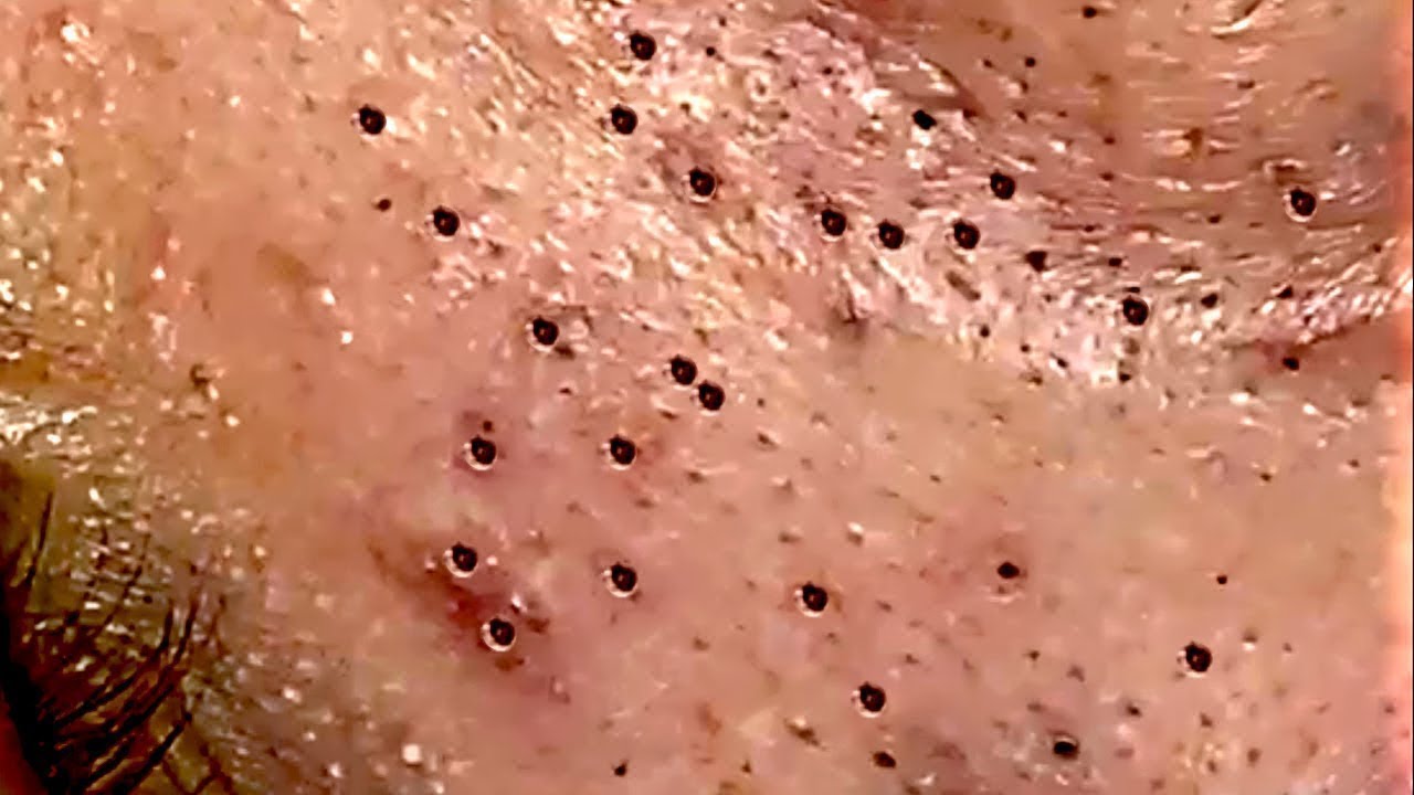 Terrible Blackhead and Cyst Popping Video