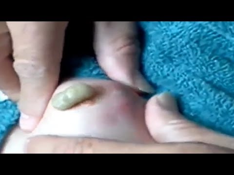 Terrible infection cyst pimple popping at home- Worst Insect Stings Ever