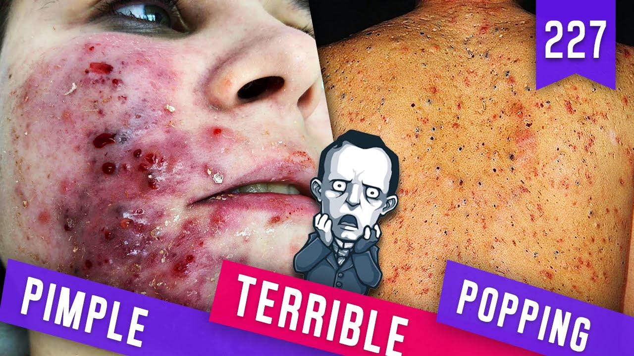 TERRIBLE PIMPLE POPPING | PIMPLE FURUNCLES | REMOVE BLACKHEADS | POPPING