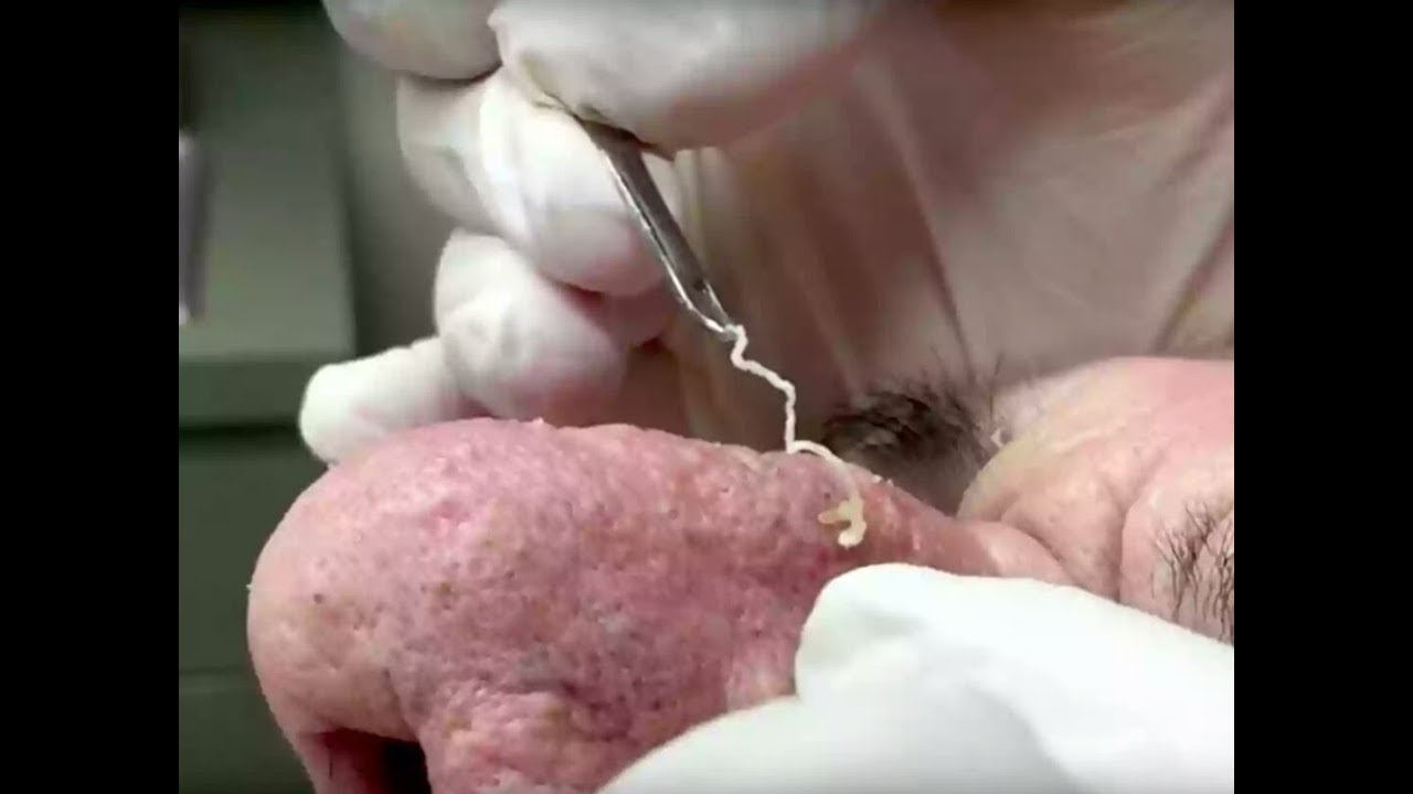 The 10 most satisfying pimple-popping viral videos of all time
