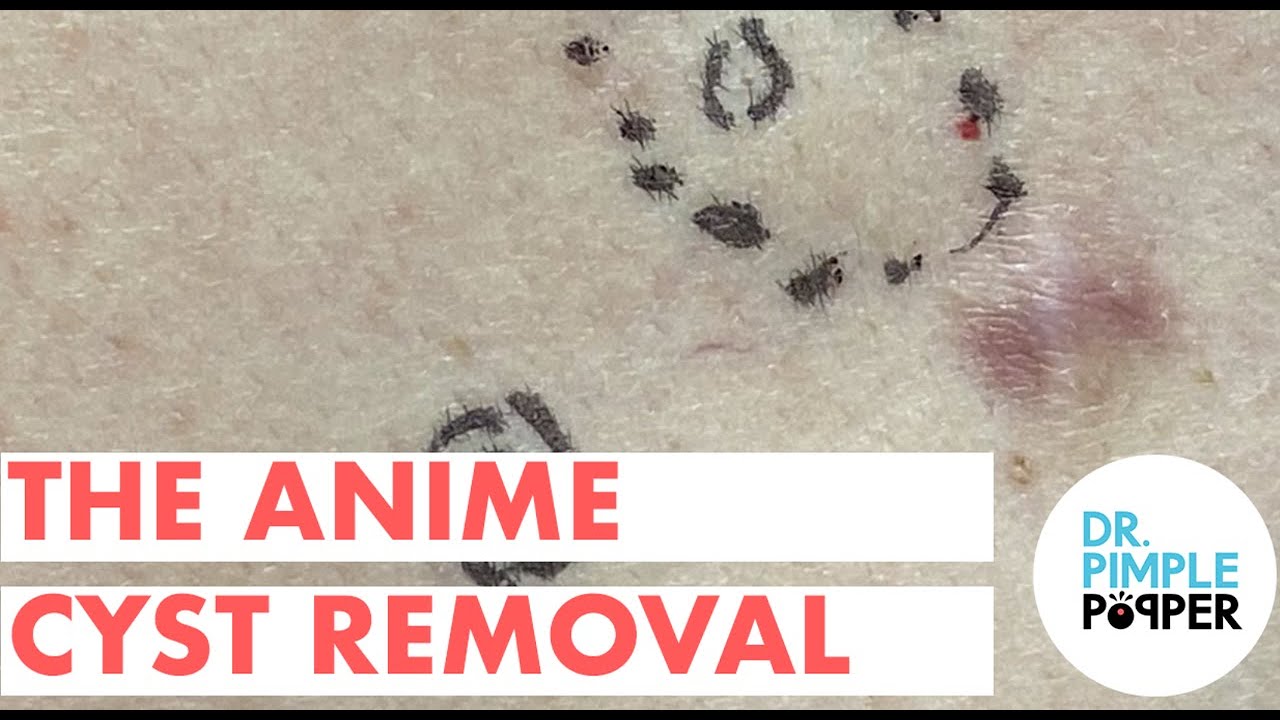 The Anime Cyst Removal